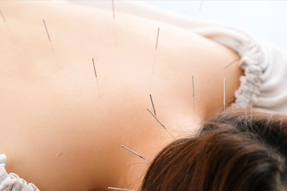 鍼灸治療